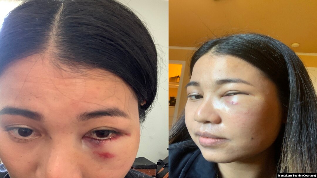 Mantakarn Seenin, A Thai woman shows her wounds on her face caused by brutally attacked while riding the BART train in San Francisco, CA.