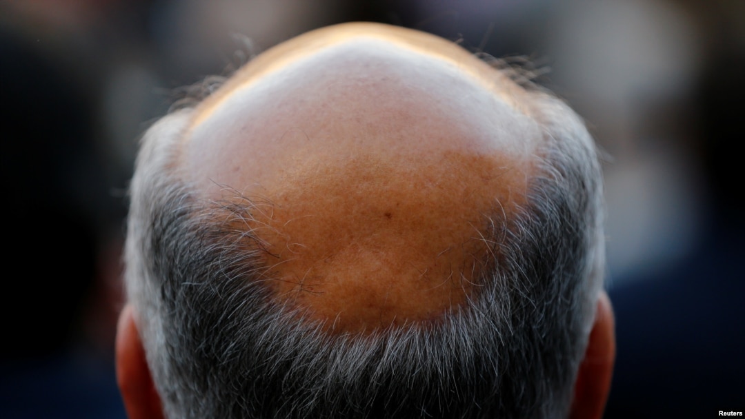 A new study has found that males of short stature are at increased risk of losing their hair prematurely, in addition to a number of other health conditions.