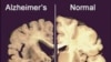 Researchers: Drug May Reverse Alzheimer’s Memory Problems