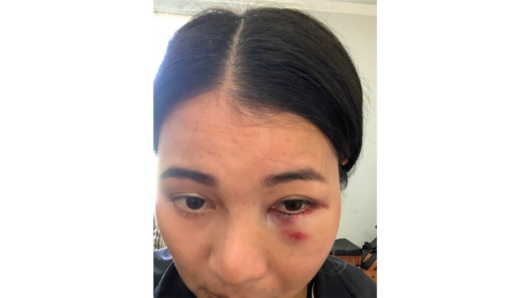 Mantakarn Seenin, A Thai woman shows her wounds on her face caused by brutally attacked while riding the BART train in San Francisco, CA.